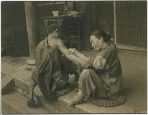 A woman with bound feet performing Chinese acupuncture on the arm of a young man